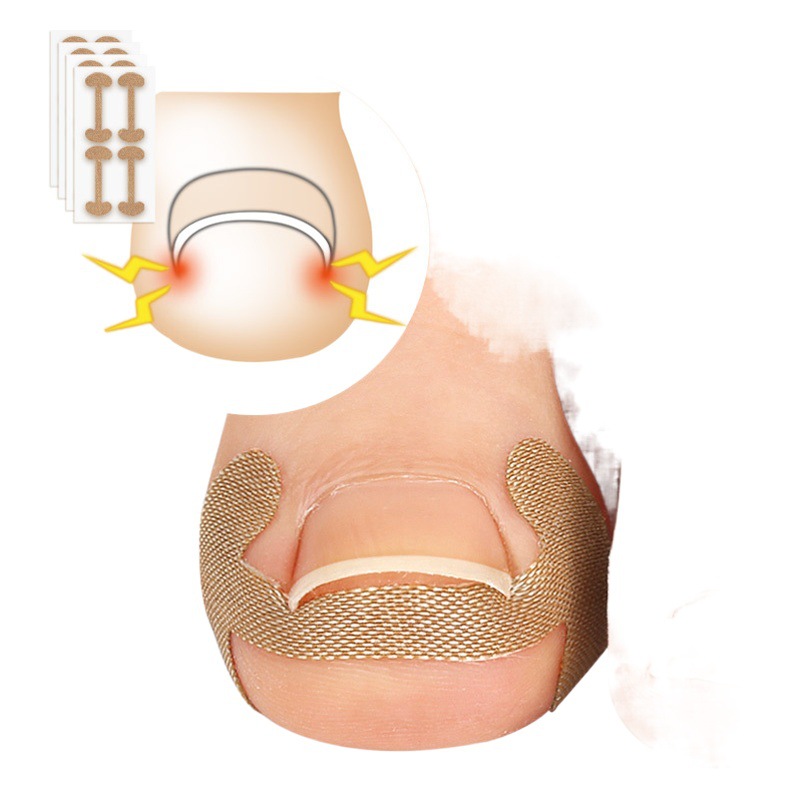 Toenail nail groove nail inlay nail foot nail orthosis thumb nail patch quick toenail repair deformation meat bag