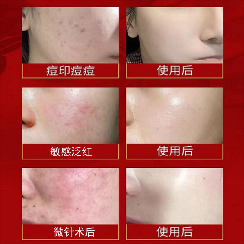 安奈雅械字号二类医用敷料术后舒缓祛红晒后敏感肌修护医用冷敷贴|undefined