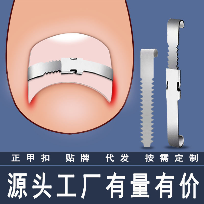 Nail button nail nail pricking lala patch toenails into the meat long pricking flesh correction nail correction appliance inflammation