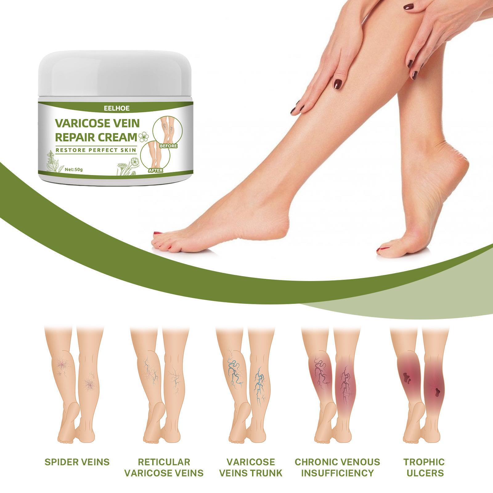 Venobalm Varicose vein cream leg swelling care cream静脉按摩曲张膏-阿里巴巴