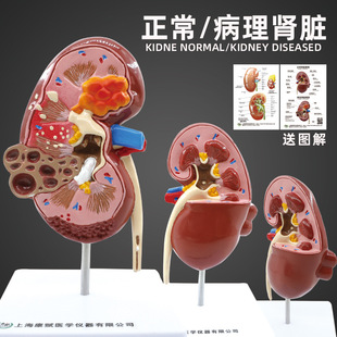 Human Kidney Anatomy Model, Diseased Kidney Model, Kidney Model, Human Internal Organ Anatomy Model