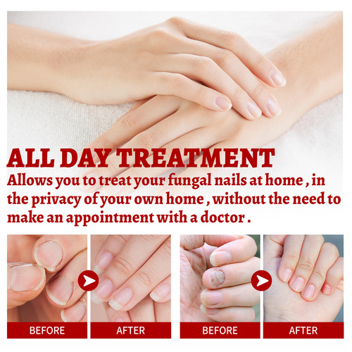 West&Month Onychomycosis Repair Solution, Hand and Foot Brightening Nails, Soft Nails, Rotten Toenails, Thickening, Nourishing Nails, Moisturizing Manicure