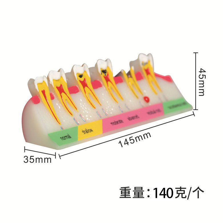 Modelo de clasificación de caries dental Demostración de la evolución de la caries dental Explicación de la comunicación médico-paciente Modelo de enseñanza dental oral