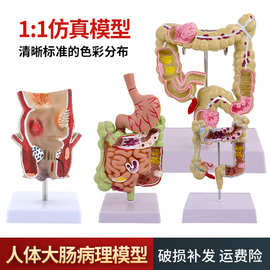 大肠病理模型 肠胃模型 大肠病变模型 肠道疾病 人体结肠病变模型