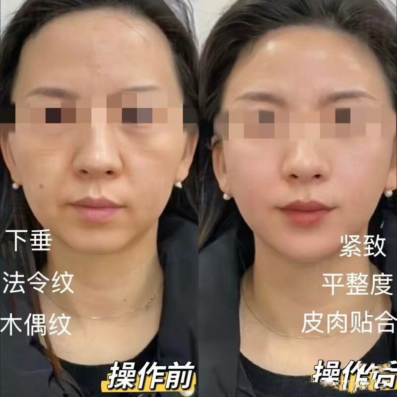 Fukofei レザーボーンウォーターライトは、ほうれい線を改善し、肌と肉を引き締め、薄いエッセンスを除去します。|undefined