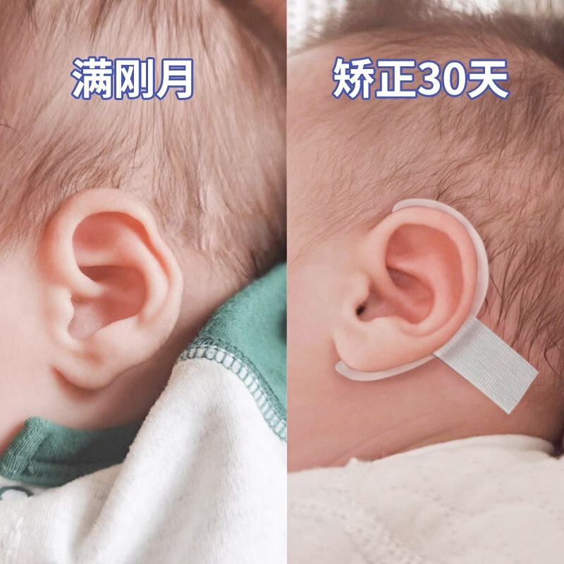 婴儿耳廓辅助器宝宝耳朵定型贴招风耳塑形新生儿硅胶带耳畸形耳撑|undefined