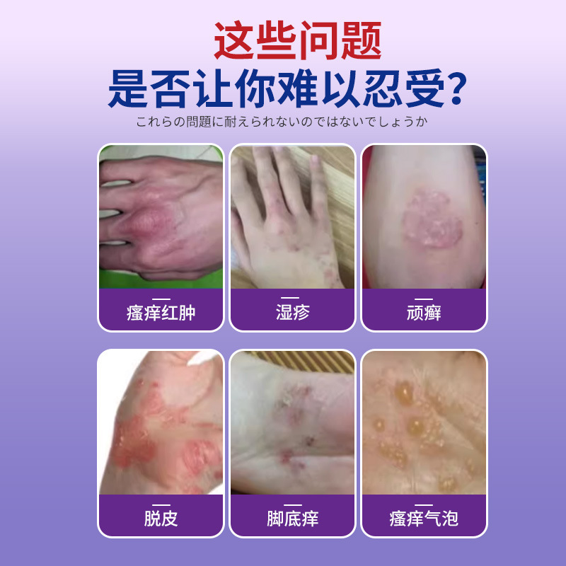 岩井弘炉甘石皮膚かゆみクリームイラクサかゆみ止め専用大人のあせも防止首工場直営|undefined