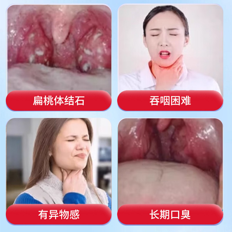 秋昃早川扁桃体结石去除喷剂口腔异味喉咙吞咽不适扁桃体护理喷雾|undefined