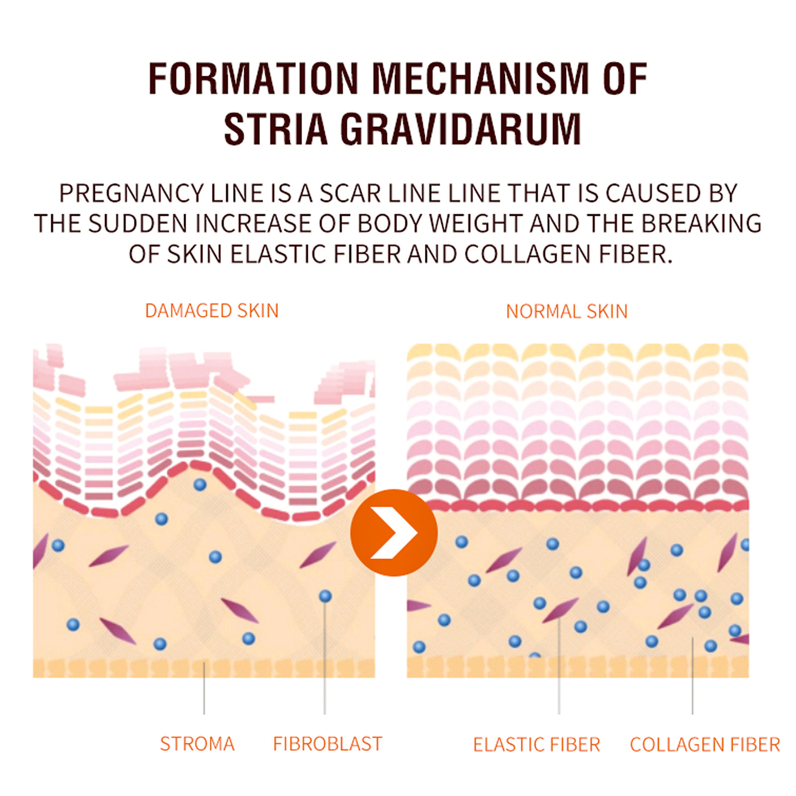 Jayswing επισκευαστικό σπρέι μετά τον τοκετό ξεθωριάζουν ρυτίδες εγκυμοσύνης υγρό περιποίησης δέρματος σώματος_voghion.com