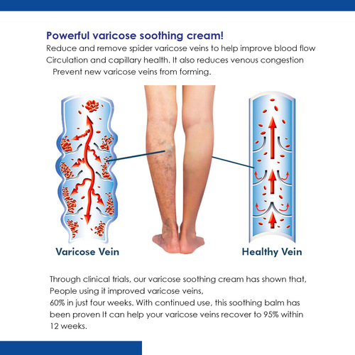 South Moon 静脉修护膏 曲张按摩缓解蚯蚓腿修护疼痛肿胀活络膏