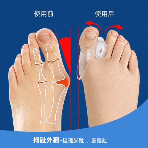 Single-hole toe separator with thumb deformity correction, overlapping big toe separation device, soft anti-friction toe orthosis