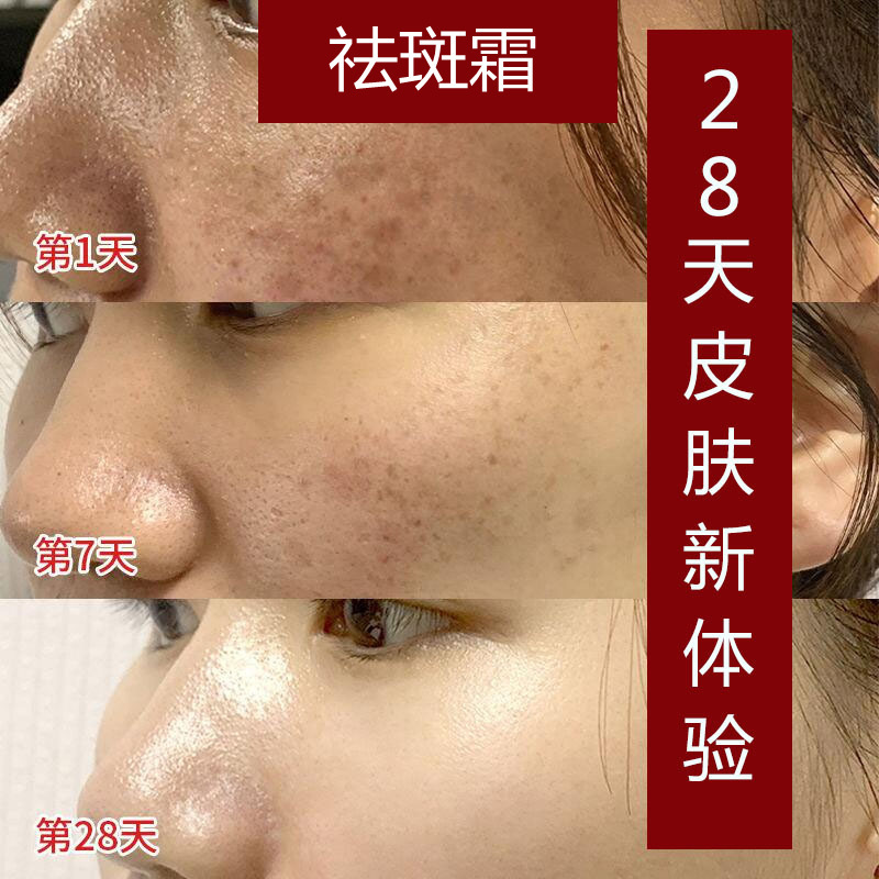 Freckle skin whitening Pale spot Chloasma Senile plaques Zhuo poem skin whitening Freckle cream wholesale