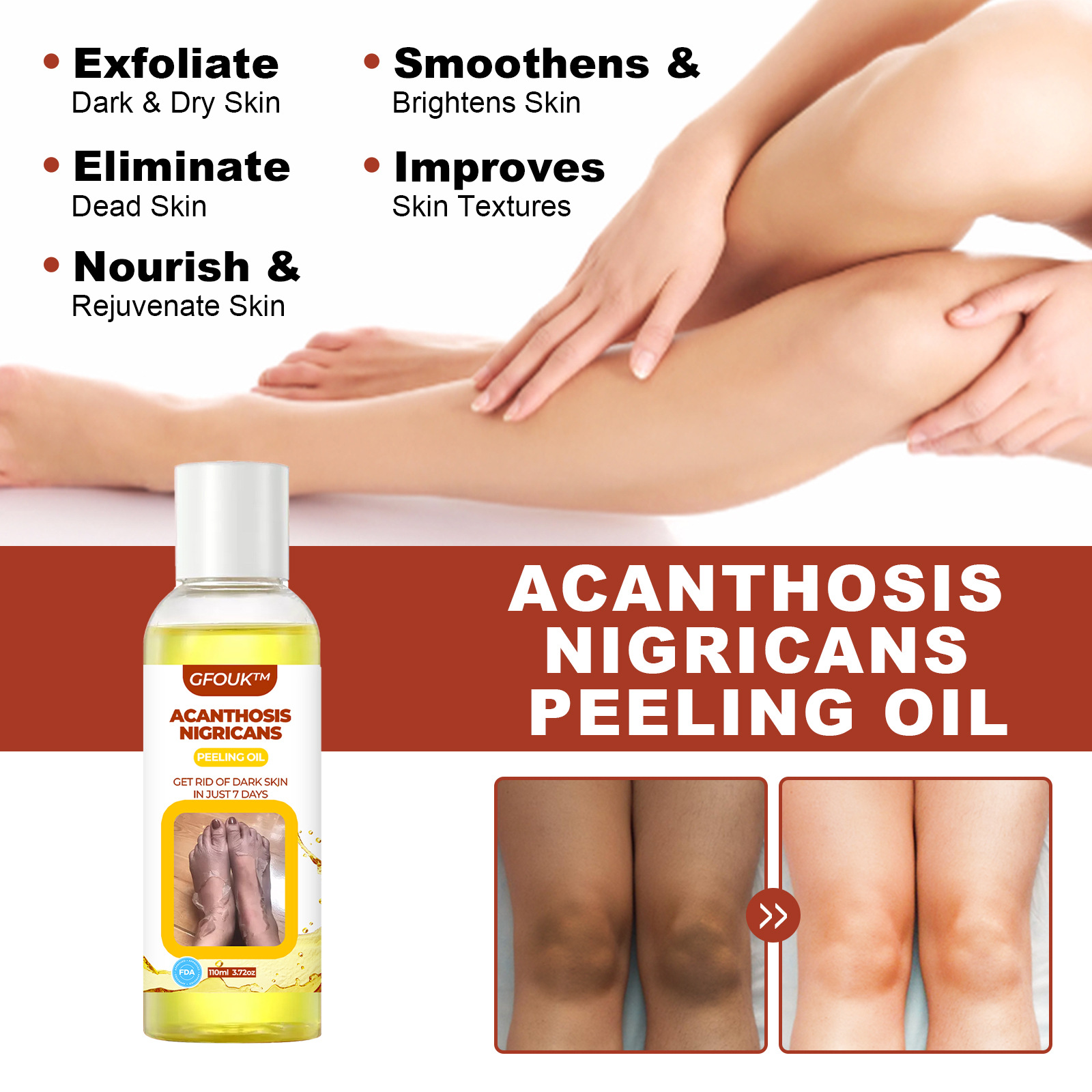 Acanthosis Nigricans Exfoliating Oil For Dark Skin And Elbows_voghion.com