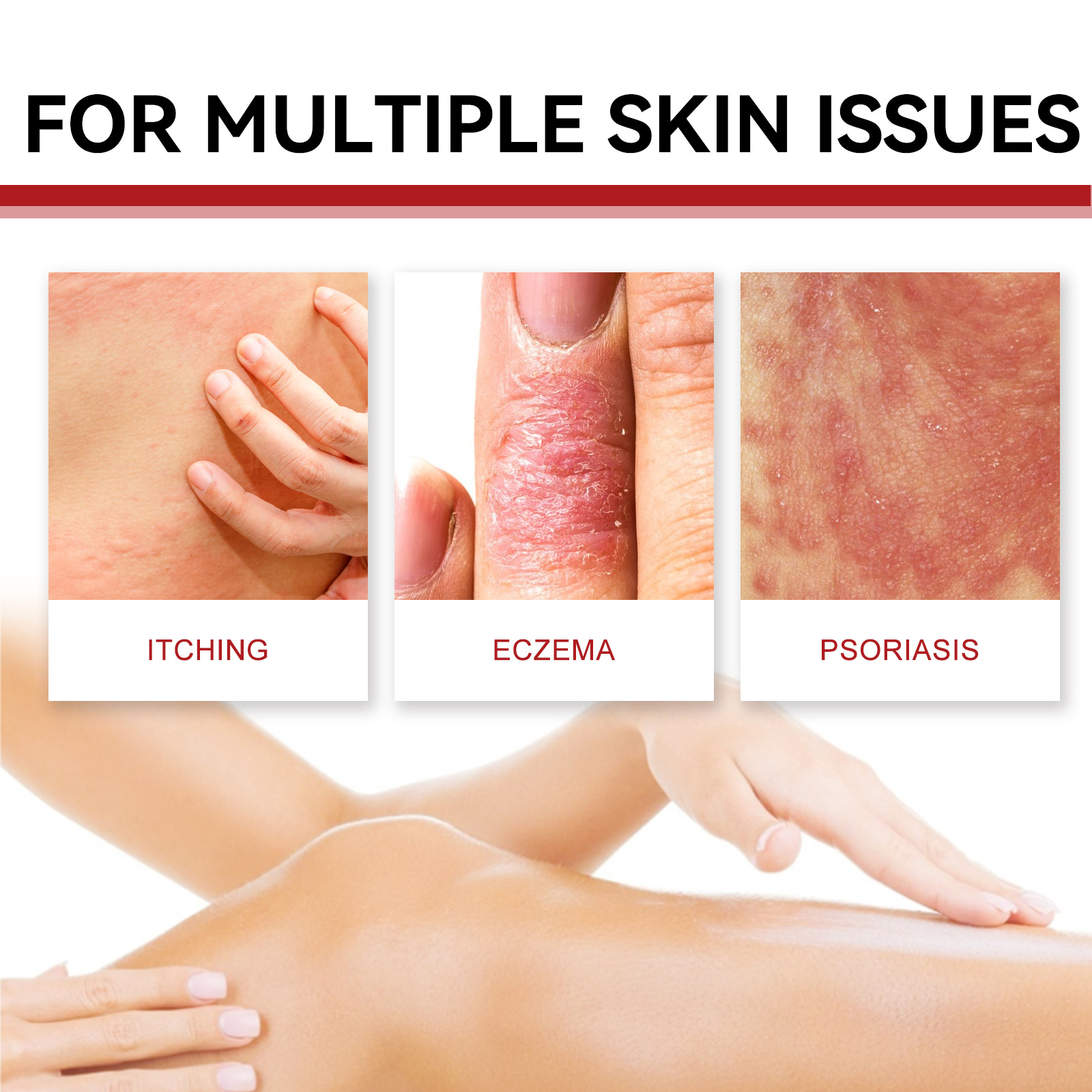 South Moon Psoriasis Care Cream Zarudnutí pokožky těla, svědění, krém proti svědění a lupénce na rukou a nohou_voghion.com