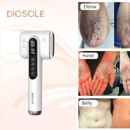 现货供应308nm紫外线光疗美容仪家用皮肤护理仪器厂家便携