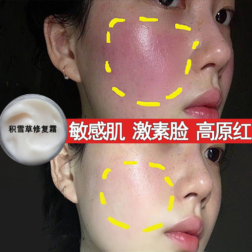 Centella asiatica repair cream removes redness, thickens cuticles, repairs sensitive muscles, hormones, face repair cream, beauty salon