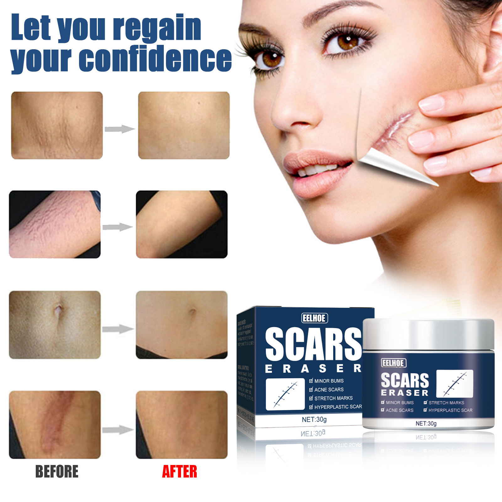 EELHOE Impacco freddo Bruciore Attenuante Riparazione chirurgica Levigante Crema gel per cicatrici cutanee_voghion.com