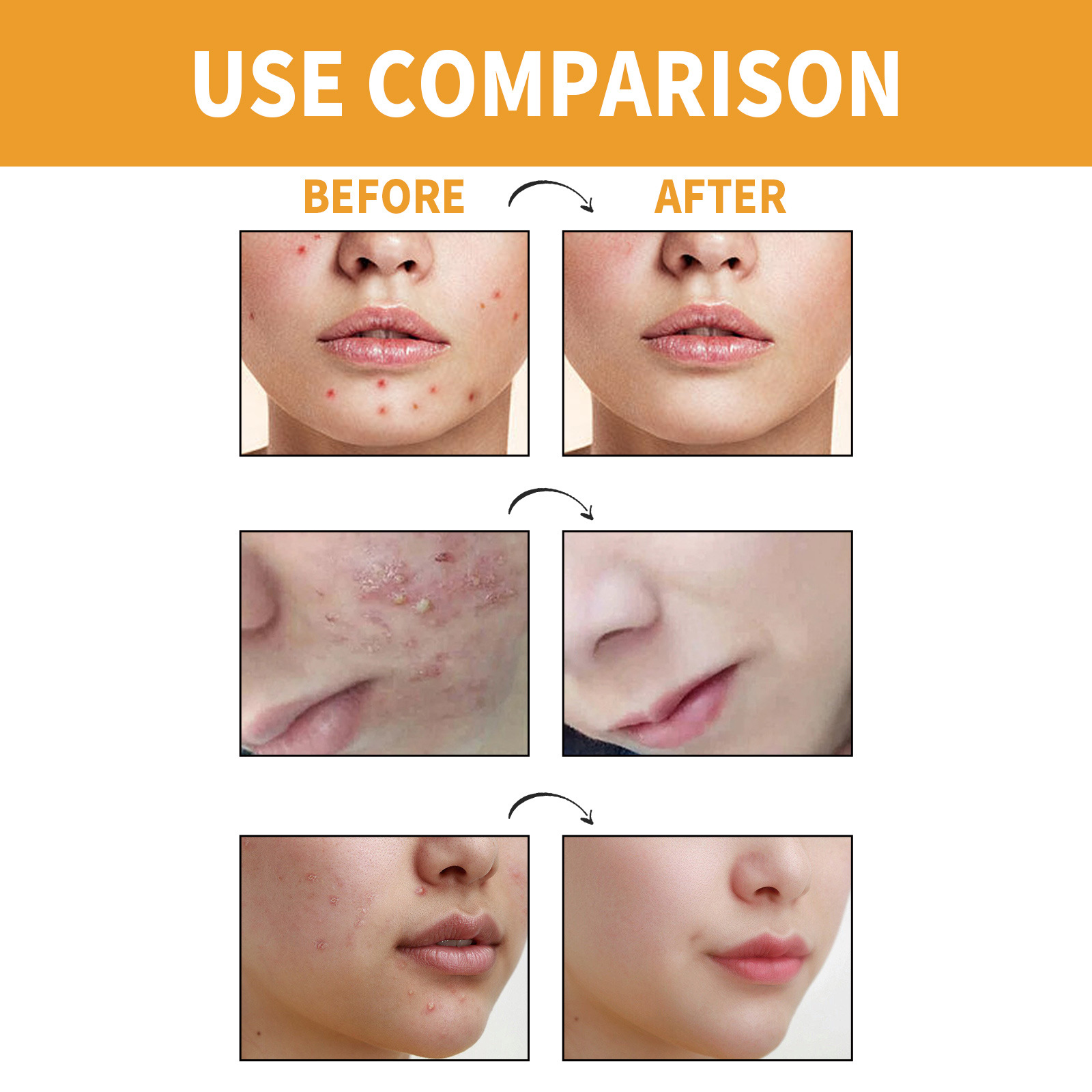 Jaysuing Chin Gel Patch de nettoyage portable pour enlever et imprimer l'acné_voghion.com