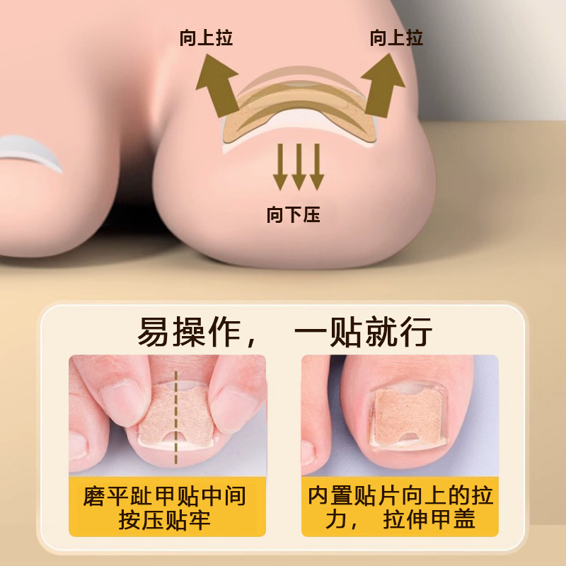Corrección de uñas artefacto ranura de uñas incrustaciones de uñas corrector de uñas dedo del pie corrección de uñas parche fuente de fábrica