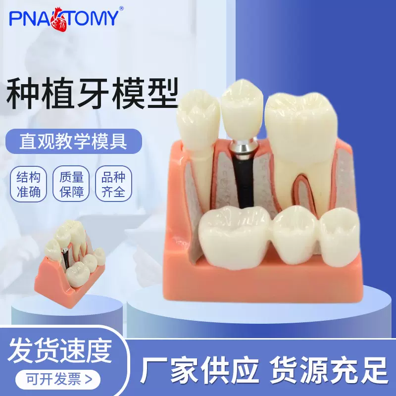 厂家供应种植牙模型 人体口腔牙齿模型透明牙模型 牙种植模型