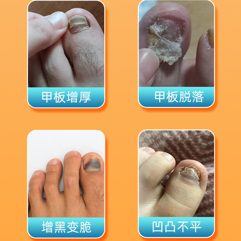 香港大药房甲康宁足部护理喷雾灰指甲液喷剂草本植物萃取厂家现货|undefined