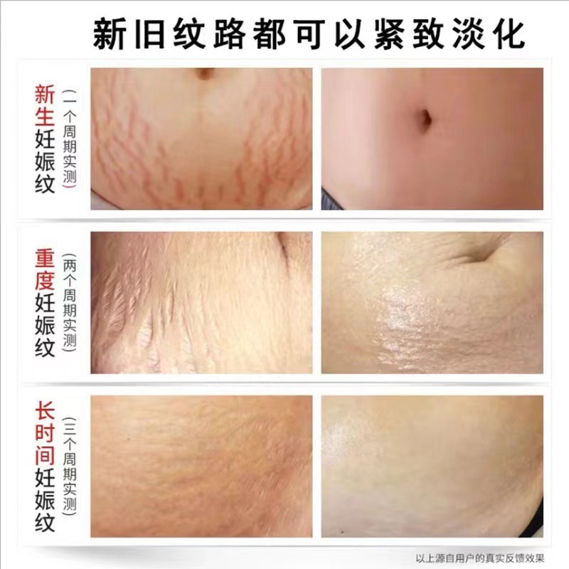 妊娠の紋様を修復して精油を薄めて妊娠の紋様を予防します。|undefined