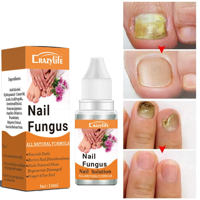 Crazylife Решение для ухода за руками и ногами Решение для ухода за ногтями 10 мл грибок ногтей 10 мл