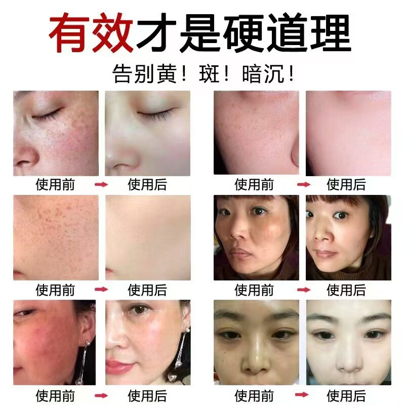 病院で人気の強力なシミ取りクリーム、美白クリーム、メラニンを分解して肌を明るくするクリーム、色調をコントロールするクリーム|undefined