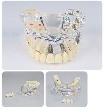 Modelo de ortodoncia dental semi-metal semibrackets Práctica de corrección de molde dental estándar Comunicación médico-paciente Modelo de enseñanza Modelo dental