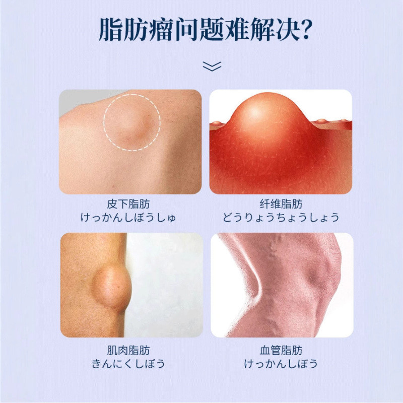 藤健郎医師の脂肪康専用軟膏、皮下脂肪除去軟膏、消散軟膏、結節腫れ工場直販|undefined