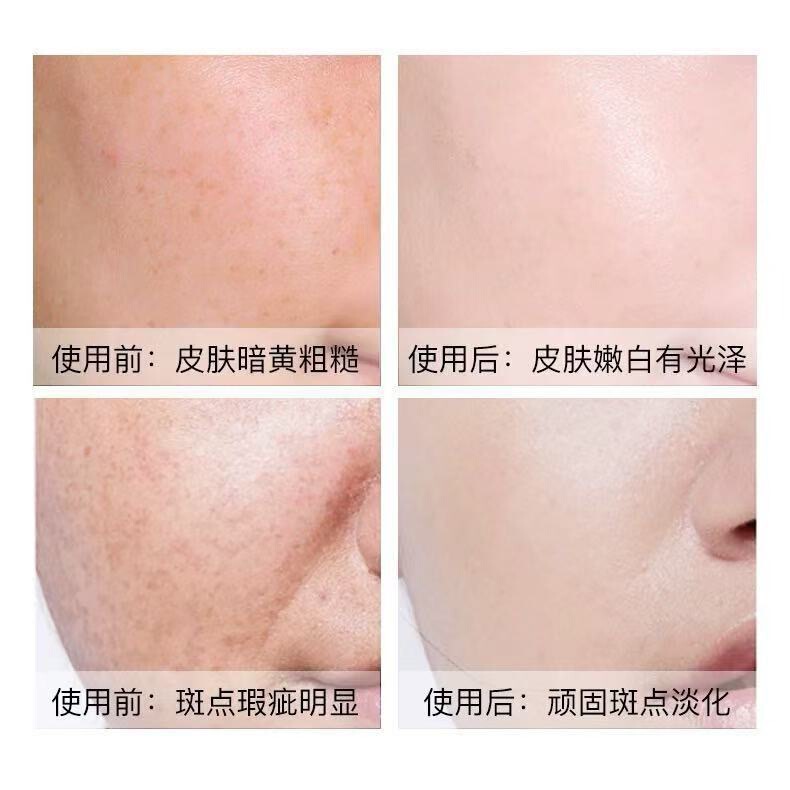 亮肤液臭臭水疏基水排铅汞斑去色斑黄褐斑雀斑分解代谢黑色素白皙|undefined