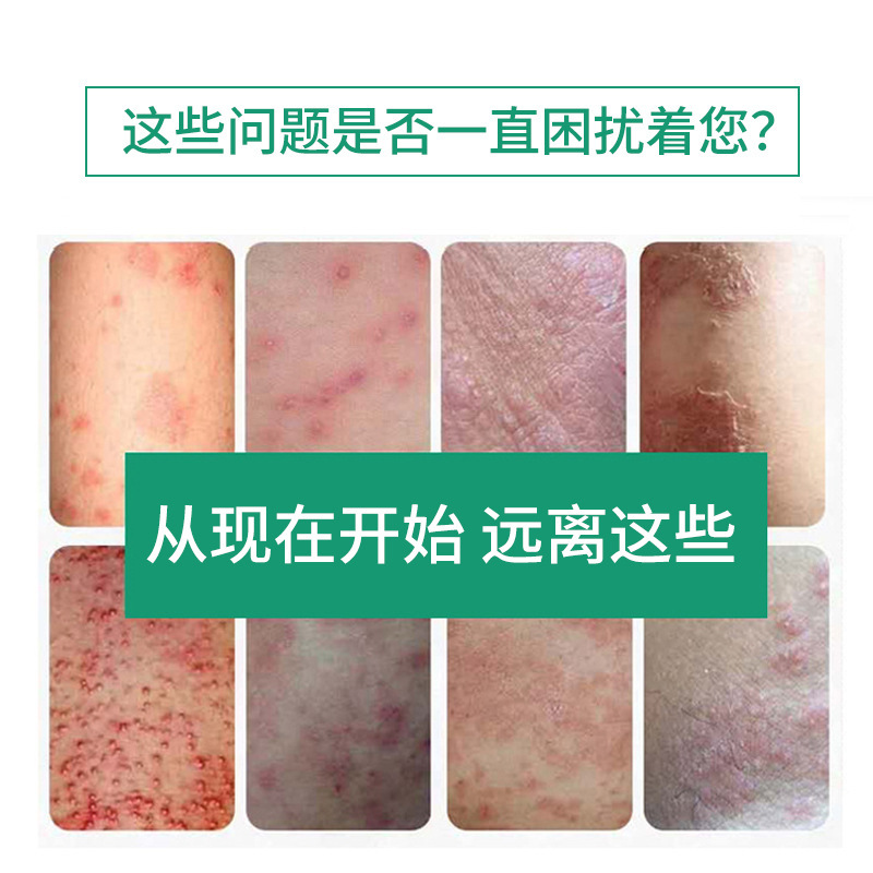 Xiangniu Miao Yao Xian, Spray para Aliviar la Picazón, Producto para el Cuidado de los Pies, Suministro para el Cuidado de los Pies, Desinfección, Cuidado Antibacteriano para los Pies