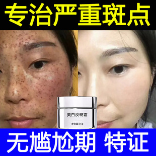 Whitening and Freckle Removal Cream, Powerful Special Certificate, Enhanced Version of Melanin Removal, Fried Spots Cream, Chloasma, Age Spots, Freckles and Freckles Removal Cream