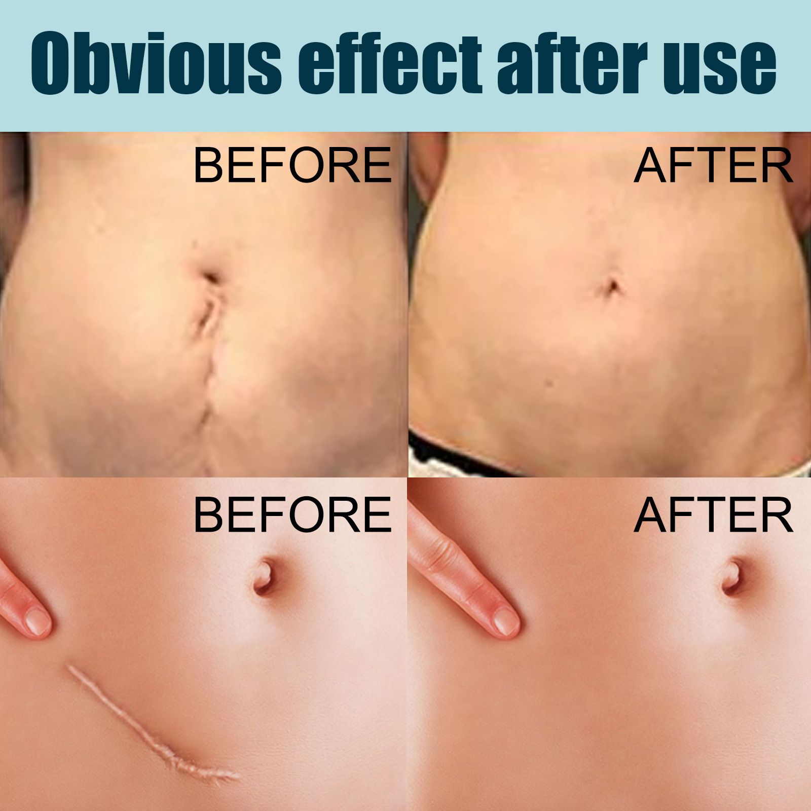 EELHOE littekenverlichtende gel, chirurgische littekenhuidhyperplasie, branden, verzorgen, gladmaken en repareren van littekens, (pak van 3)_voghion.com