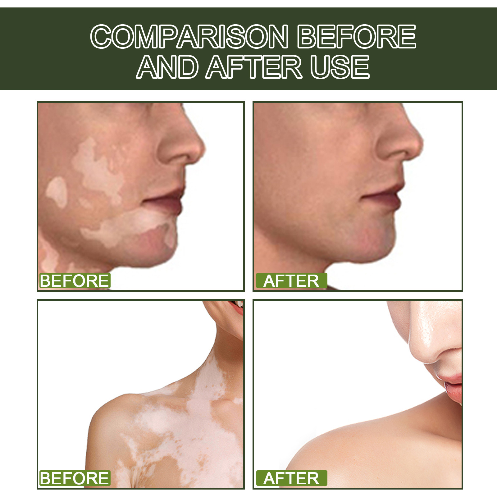 EELHOE Entferner Haut Leukoplakie Schweißfleckennetz Außenpflege Psoralen Essenz_voghion.com