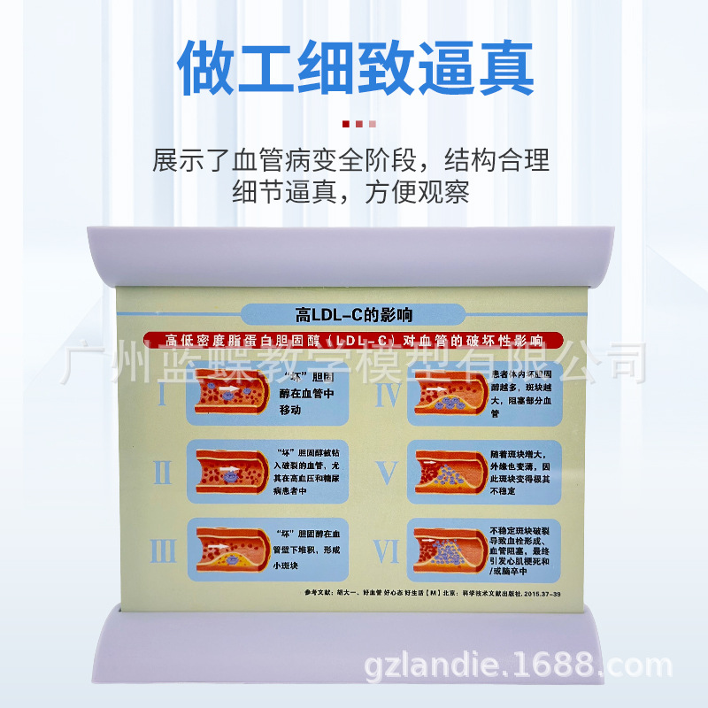 Ѫ�ܷ������Ѫ֬��Ѫ֬ģ�Ͳ�����̬Ӳ������Ѫ˨ֱ�۽�ѧ����