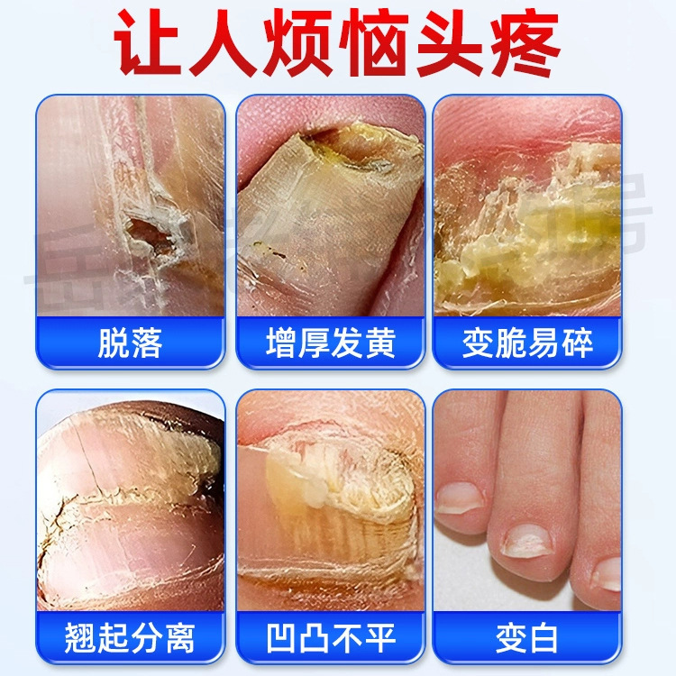 正虎制药灰甲康保健液灰甲净指甲增厚软甲液草本护理膏灰指甲液|undefined