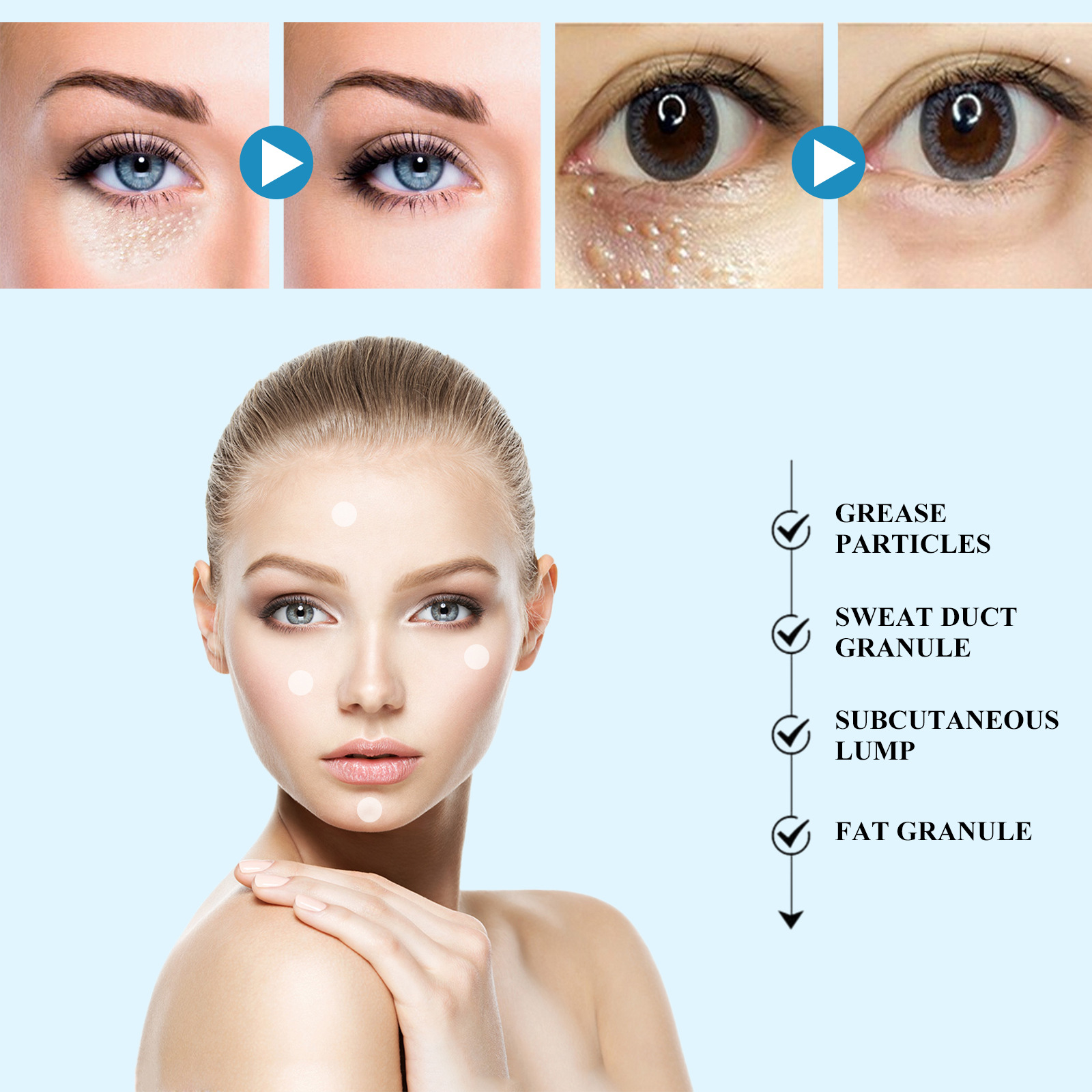 Lõunakuu rasv õligraanulite eemaldamiseks, näo nahaalused massid, tavaline higipiibu graanulite parandav plaaster_voghion.com