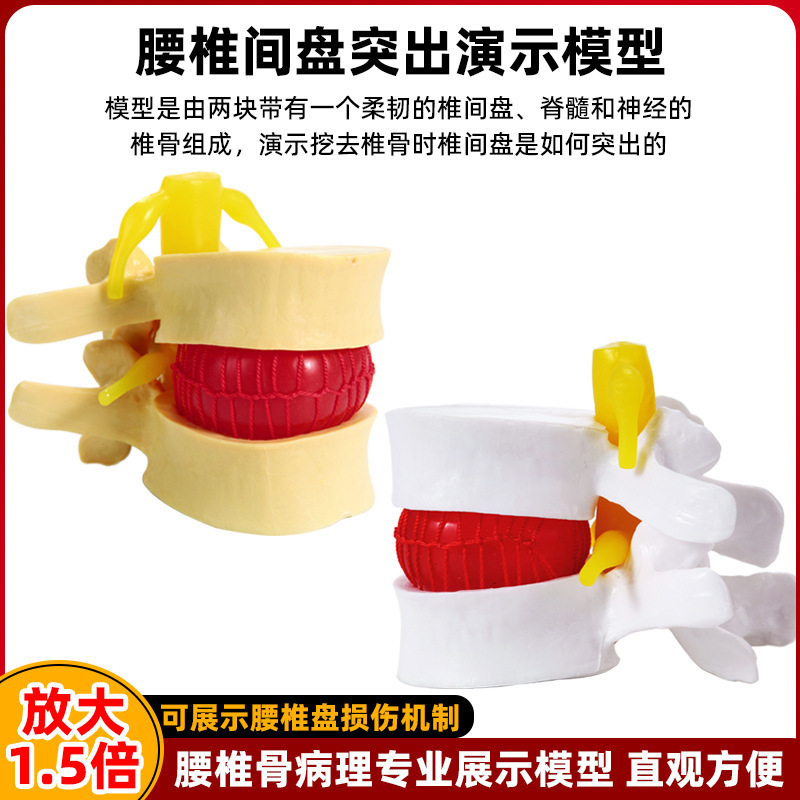 Intervertebral Disc Model genuine goods Medicine Human Lumbar Protrusion Spine Spine Pathology Demonstration Joint Standard Model Intervertebral Disc Model genuine goods Medicine Human Lumbar Protrusion Spine Spine Pathology Demonstration Joint Standard Model