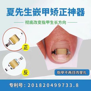 Nail nail patch nail groove nail correction device nail buckle nail patch nail correction patch nail correction