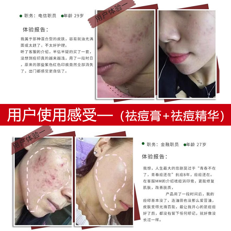 ハーブニキビクリームメーカー、ニキビ跡を薄くし、ニキビを取り除き、ニキビを閉じ、鎮静し、修復し、美容室のニキビクリーム|undefined