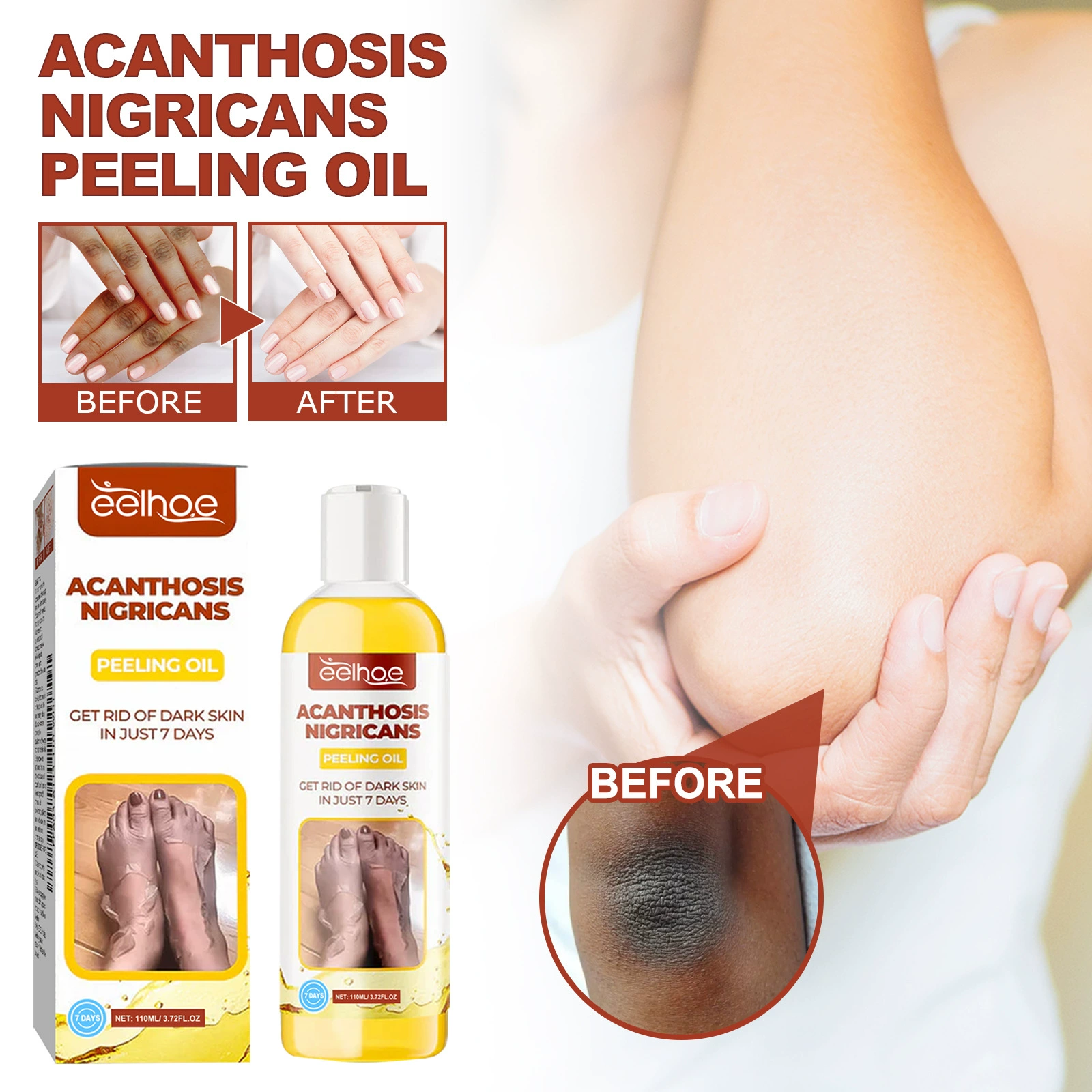 EELHOE Acanthosis Nigricans Масло для кутикулы Подмышки Суставы Тело Очищение кожи Кутикула Увлажняющее масло для красоты кожи