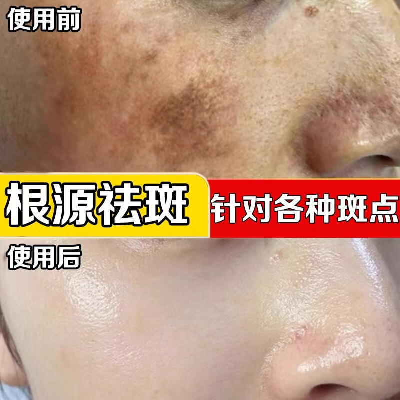 国境を越えたクリニック用そばかす除去液、そばかす溶解美白エッセンス、そばかす除去、色素除去、色素分解原液、外国貿易|undefined