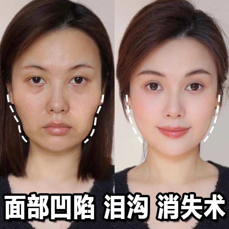 顔の豊満な液豊のこめかみは顔のくぼみを埋めて涙の溝の法律の紋様を取り除きます。|undefined