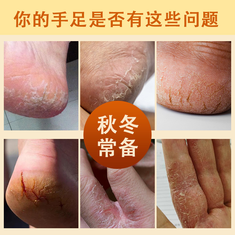 香港大薬局 ジーヤイシン 馬油ひび割れクリーム ひび割れクリーム 腫れ痛 足のひび割れ乾燥ひび割れクリーム 手足保湿クリーム 在庫あり|undefined