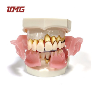 Um-4024-2 Oral Teaching Dental Model Severe Inflammation of Gingiva with Calculus Gingiva Hard Periodontal Model