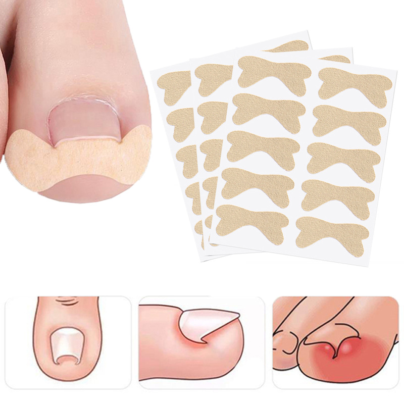 Glue-free nail paste nail meat separation toenail correction paste inlaid nail paste groove nail buckle straightener pull paste