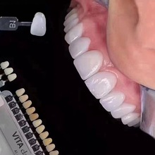 美牙全瓷贴面冰瓷贴面琥珀瓷蓝瓷陶瓷贴片教学