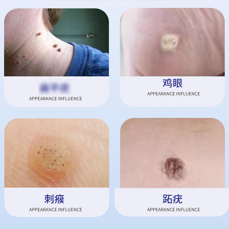 三田制药尤肤平保健液植物提取点痣保健膏自然脱落 30ml/瓶批发|undefined