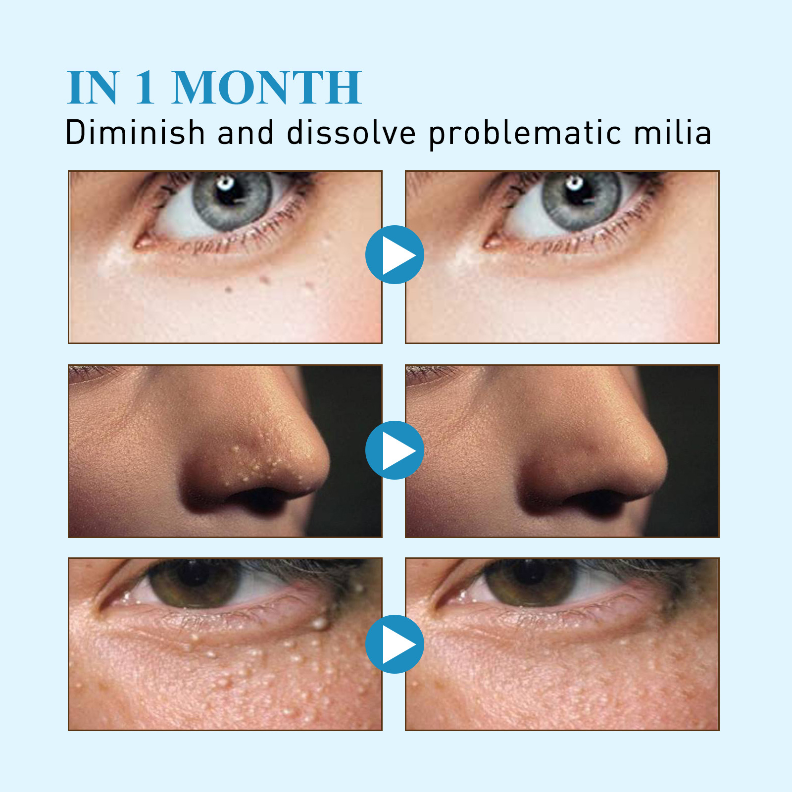 Lõunakuu rasv õligraanulite eemaldamiseks, näo nahaalused massid, tavaline higipiibu graanulite parandav plaaster_voghion.com